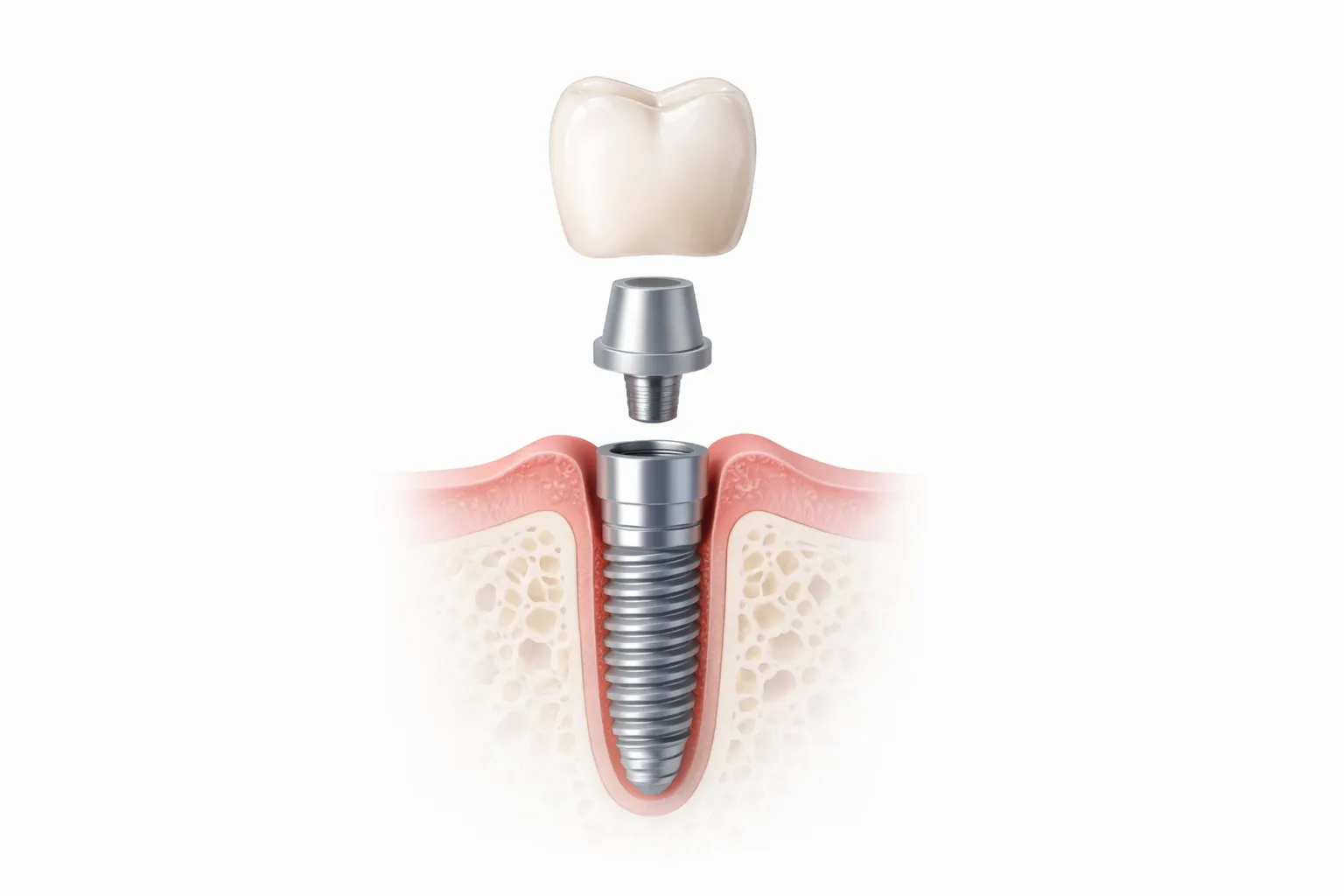 Dental Implant Procedure